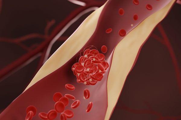 Medicamentele care scad colesterolul ar putea reduce și riscul de demență, conform unui nou studiu amplu