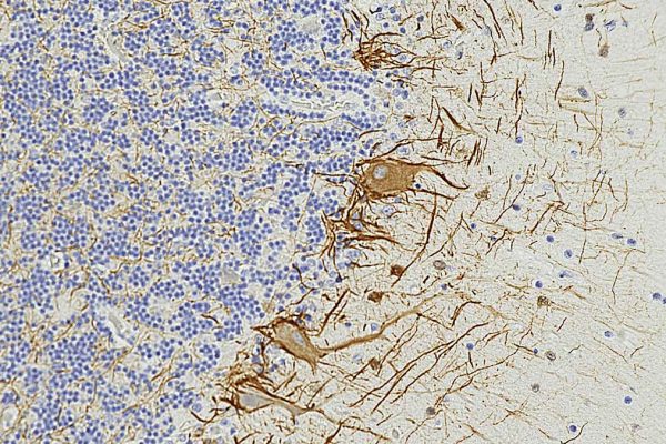 Semnale din Sânge Ar Putea Prezice Scleroza Multiplă cu 7 Ani înainte de Simptome