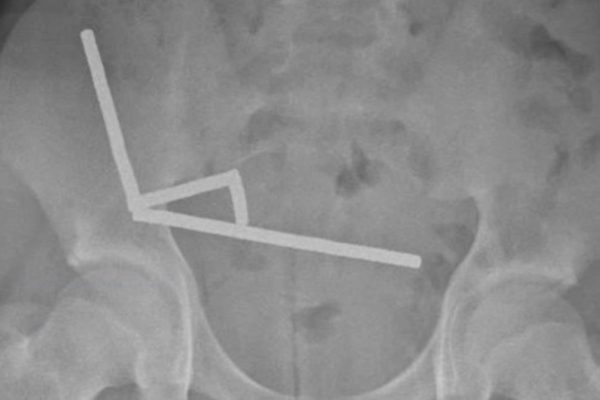 Adolescent din Noua Zeelandă pierde o parte din intestin după ce a înghițit aproape 200 de magneți