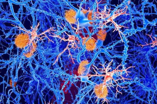 Celule ‘Tinere’ ale Sistemului Imunitar Reușesc să Inverseze Parțial Simptomele Alzheimer la Șoareci