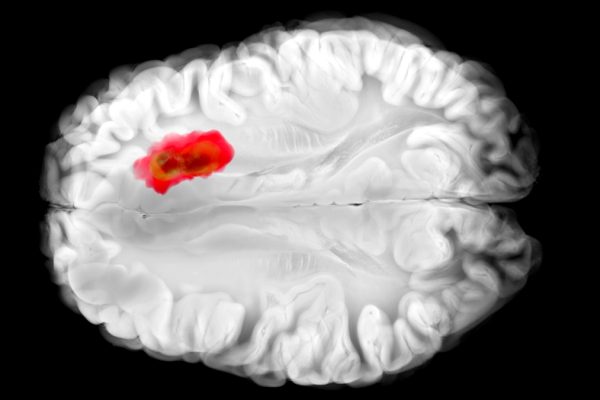 Descoperire importantă: Un Medicament Comun Pare să Lupte împotriva unuia dintre Cele Mai Mortale Cancere Cerebrale