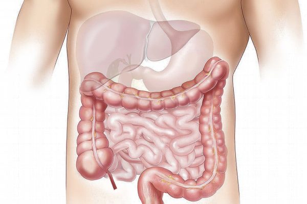 Cum cancerul colorectal evită imunoterapia folosind o barieră duală