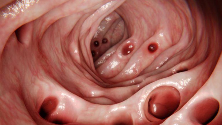 De ce dezvoltă majoritatea oamenilor diverticuloză în intestin la vârsta de 80 de ani… șI ce este aceasta?