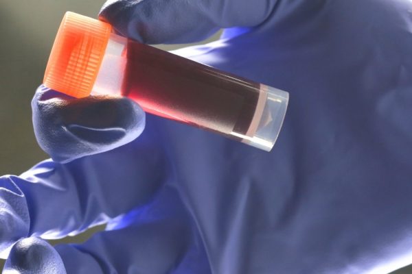 Tipul tău de sânge afectează riscul de AVC precoce, relevă un studiu