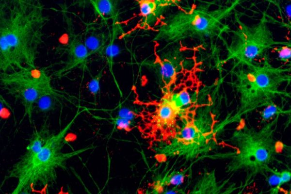 Descoperire: Leziunile cerebrale de tip prion pot apărea fără prezența prionilor infecțioși, relevă un studiu