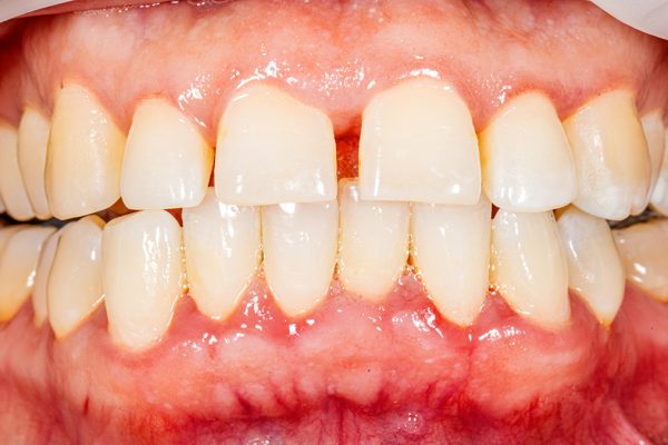 Starea dinților tăi ar putea prezice o moarte prematură, arată un studiu