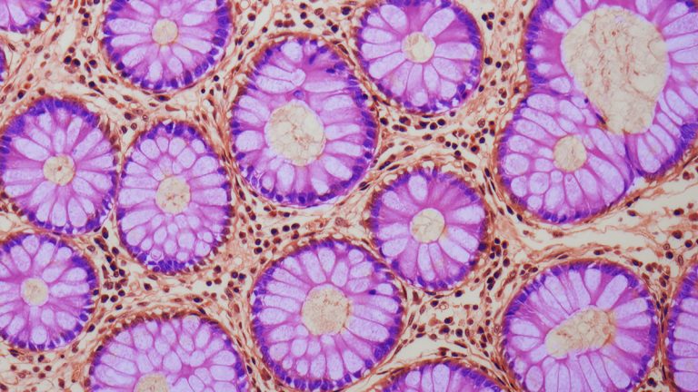 Un Semn Ascuns de Avertizare Descoperit în Intestin Poate Crește Riscul de Cancer