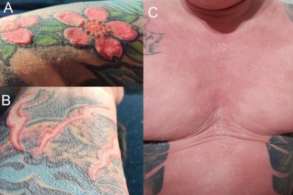 Reacții Imune Șocante Induse de Tatuajele Roșii într-un Bărbat din Polonia