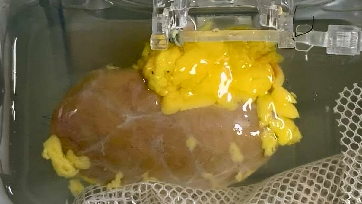 Descoperire majoră: Cercetătorii au creat un rinichi „universal” potrivit pentru orice grupă de sânge