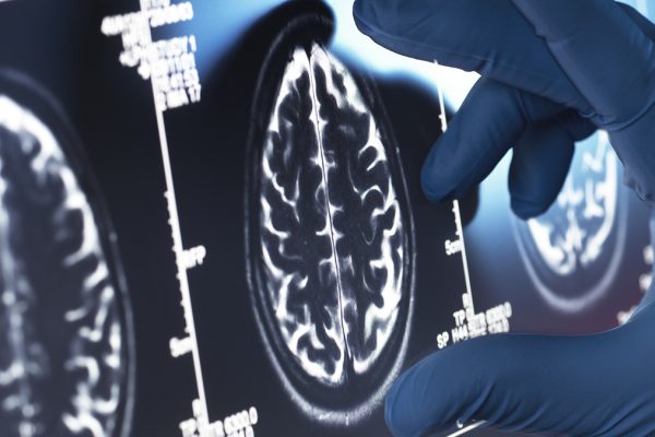 Potențialul extraordinar al Viagra în tratarea Alzheimerului