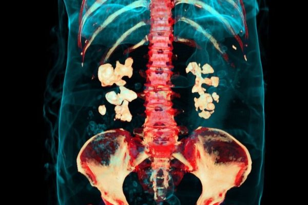 Bacteriile joacă un rol anterior necunoscut în formarea calculilor renali, relevă un studiu