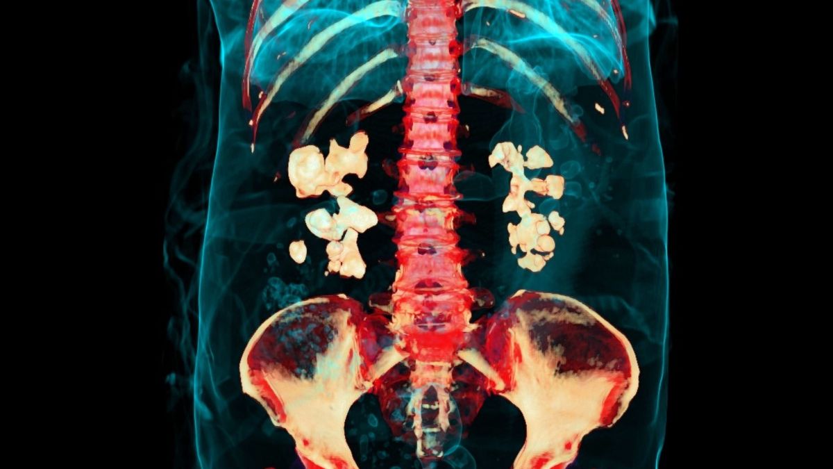 Bacteriile joacă un rol anterior necunoscut în formarea calculilor renali, relevă un studiu