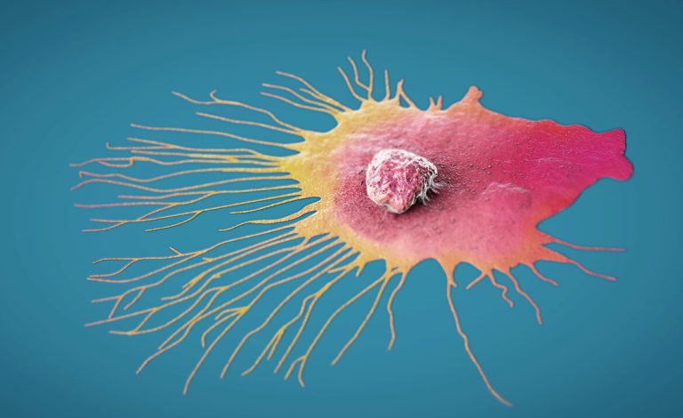 Secretele celulelor de cancer de sân metastatice dezvăluite de nivelurile de Prrx1