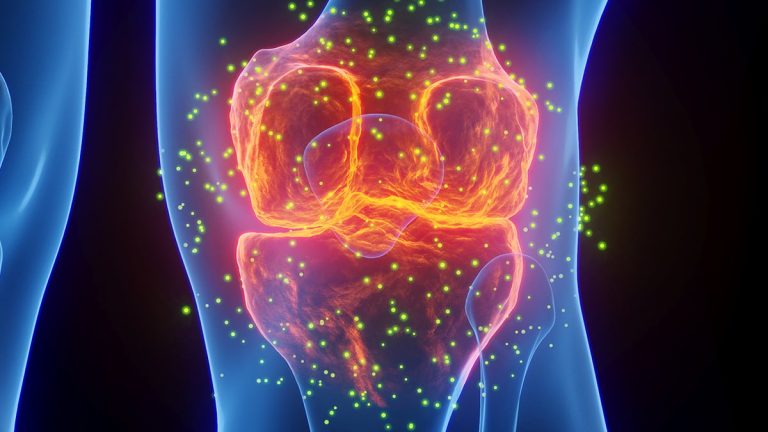 Medicamentele Comune pentru Gută Reduc Riscul de Infarct și Accident Vascular Cerebral