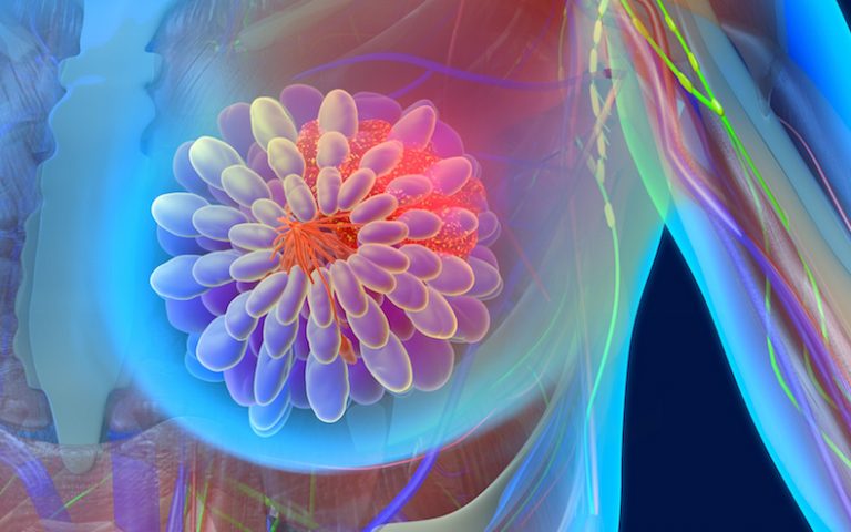 Inteligența Artificială Demonstrează Valoarea în Prezicerea Cancerului de Sân