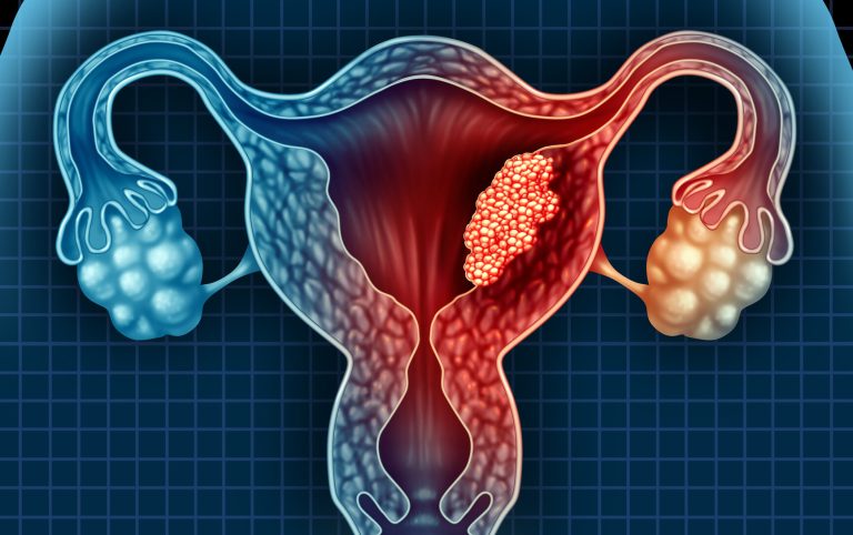 Terapia cu Conjugat Anticorp-Medicament, Eficientă în Cancerul Uterin Dificil de Tratat