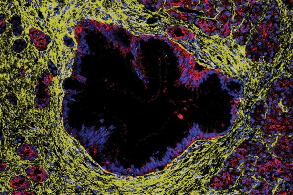 Lecțiile precursoare ale pancreasului pre-cancerigen nu duc întotdeauna la cancer