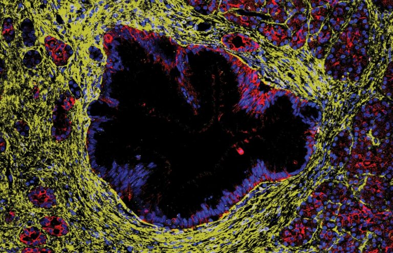 Lecțiile precursoare ale pancreasului pre-cancerigen nu duc întotdeauna la cancer