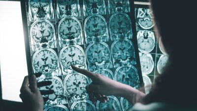 Rolul glicozilării în boala Alzheimer