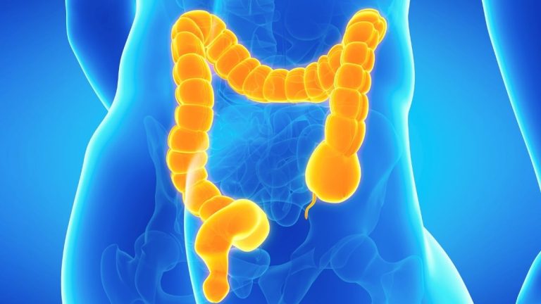 Cum poate deveni constipația periculoasă din cauza unei condiții rare a intestinului