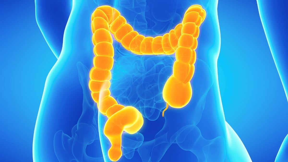 Cum poate deveni constipația periculoasă din cauza unei condiții rare a intestinului