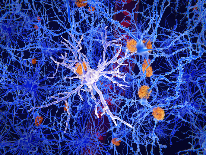 Mutații legate de vârstă în celulele imune ale creierului asociate cu inflamația în Alzheimer