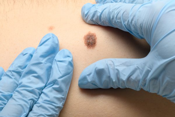 Experții Medici Încă Îi Depășesc pe AI în Diagnosticul Cancerului de Piele