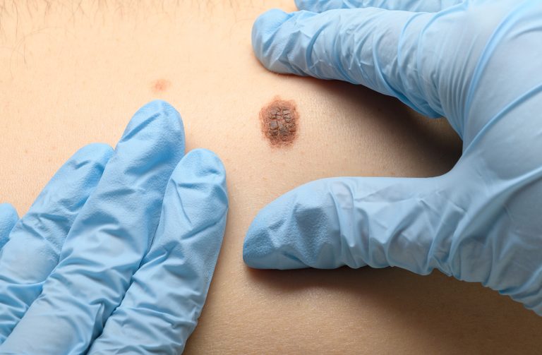 Experții Medici Încă Îi Depășesc pe AI în Diagnosticul Cancerului de Piele