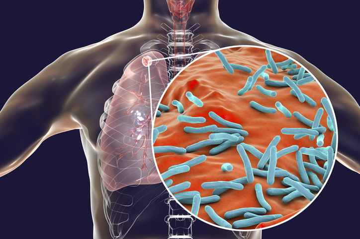 Testul de Sânge, O Nouă Speranță ca Instrument Rapid de Triaj pentru Tuberculoza Pulmonară