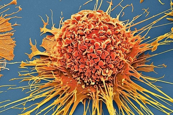 Tehnica fără chimioterapie care distruge 99% din celulele canceroase în laborator