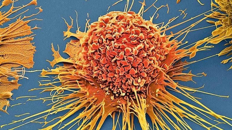 Tehnica fără chimioterapie care distruge 99% din celulele canceroase în laborator