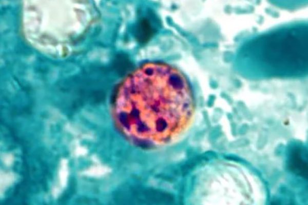Epidemia de Diaree Explosivă ia Amploare în Statele Unite în Prezent