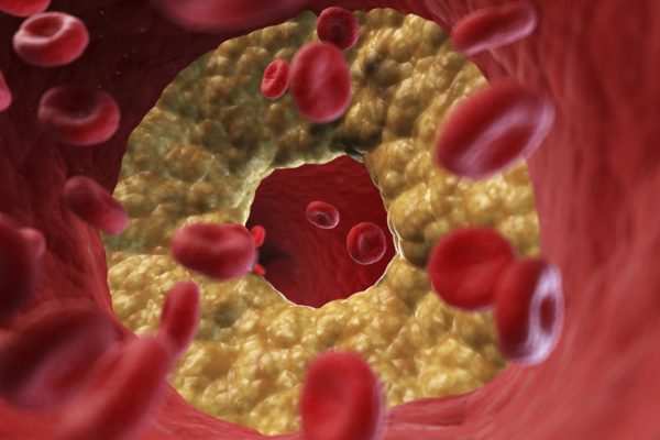 O pastilă revoluționară: Cu inhibitorul oral PCSK9 al Merck, se schimbă grija față de LDL-C?