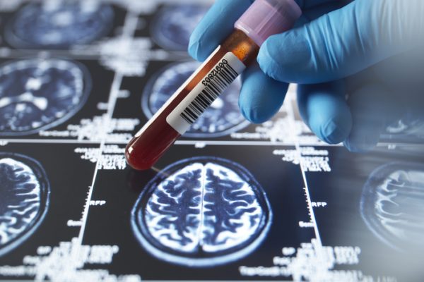Descoperirea ARN circular din sânge poate prezice Alzheimer-ul cu ani înainte de debutul simptomelor