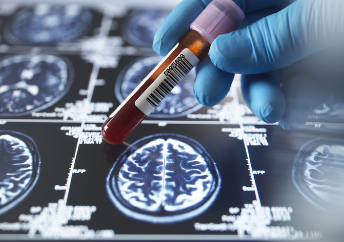 Descoperirea ARN circular din sânge poate prezice Alzheimer-ul cu ani înainte de debutul simptomelor
