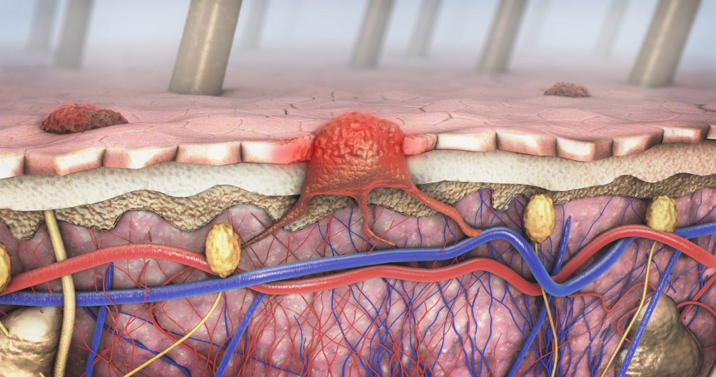 Terapia personalizată ar putea învinge rezistența în melanomul metastatic