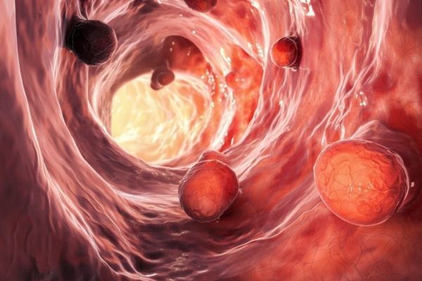 Microbiomul Intestinal Ar Putea Rămâne Perturbat Peste o Decadă După Îndepărtarea Polipilor