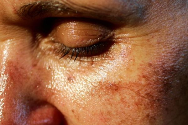 Riscul unui Medicament Illicit de Bronzare Injectabil care Face Furori pe TikTok – Și Care Poate Provoca Apariția de Alunițe Periculoase