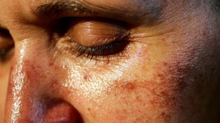 Riscul unui Medicament Illicit de Bronzare Injectabil care Face Furori pe TikTok – Și Care Poate Provoca Apariția de Alunițe Periculoase