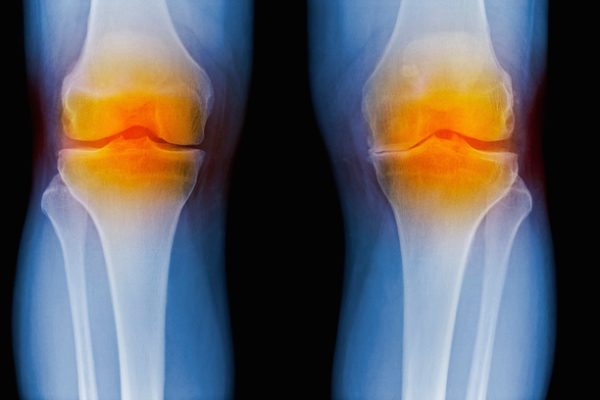 Descoperiri în Genomică și Inteligență Artificială Identifică un Candidat de Medicament Modificator al Bolii pentru Osteoartrită