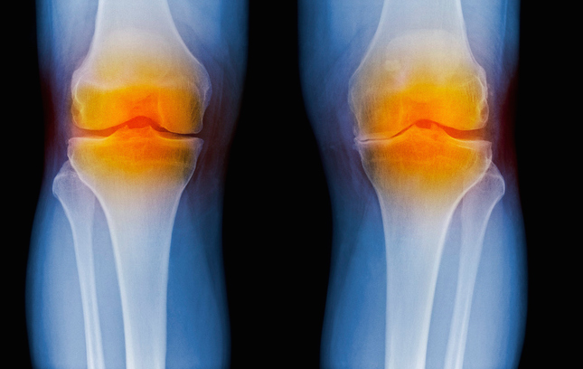 Descoperiri în Genomică și Inteligență Artificială Identifică un Candidat de Medicament Modificator al Bolii pentru Osteoartrită