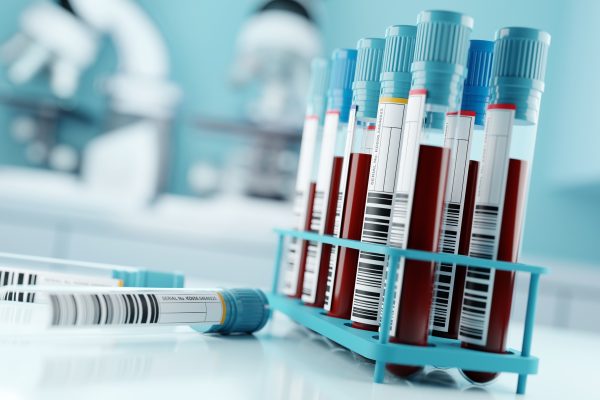 Testul sanguin FDA aprobat pentru Alzheimer marchează o schimbare către diagnosticarea mai timpurie și mai puțin invazivă
