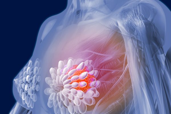 Descoperit un Comutator Molecular care Conduce Metastaza Cancerului de Sân Triplu-Negativ