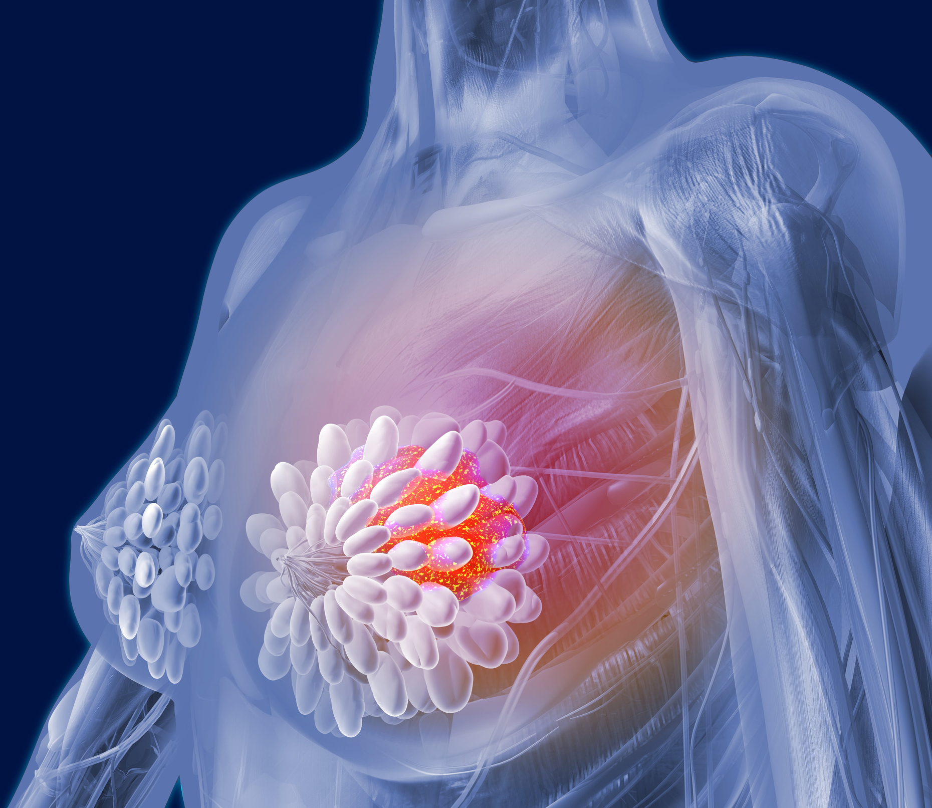 Descoperit un Comutator Molecular care Conduce Metastaza Cancerului de Sân Triplu-Negativ