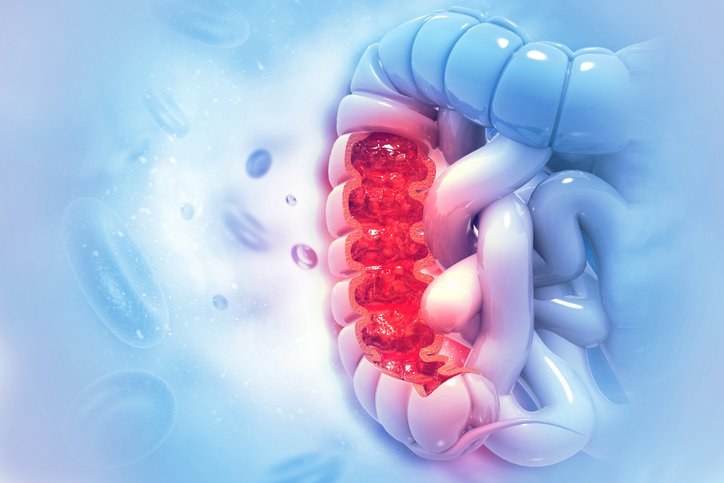 Inteligența Artificială conștientă de Microbiom descoperă noi combinații de medicamente pentru cancerul colorectal