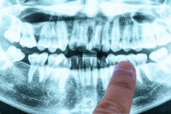 Sângerările gingivale ar putea fi un Semn Timpuriu al unei Probleme Mult Mai Mari