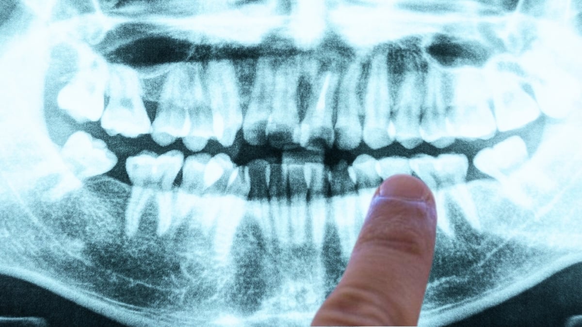 Sângerările gingivale ar putea fi un Semn Timpuriu al unei Probleme Mult Mai Mari