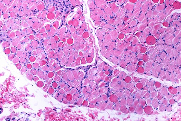 Terapia cu Oligonucleotide Superîncărcate arată promisiuni pentru Distrofia Musculară Duchenne