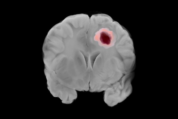 Potențialul de Top al Terapiilor cu CAR T Induse de CD276 Intracraniene în Glioblastom