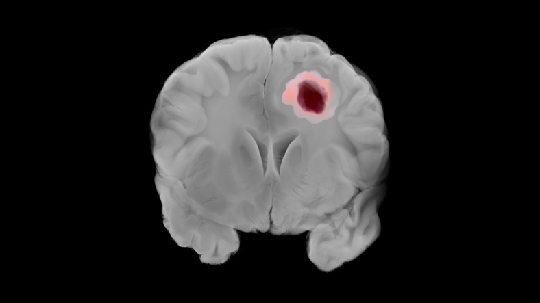 Potențialul de Top al Terapiilor cu CAR T Induse de CD276 Intracraniene în Glioblastom